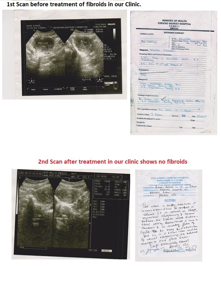 FIBROIDS TESTIONY PT KIRUI FIBROIDS TESTIONY PT KIRUI