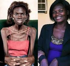 Picture of a HIV SICK PERSON Picture of a HIV SICK PERSON