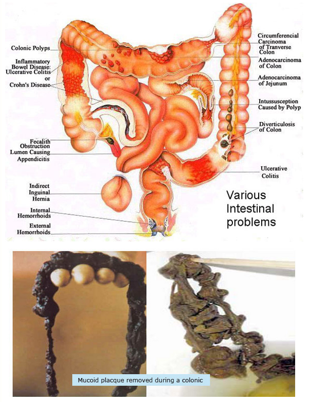 Colon Colon