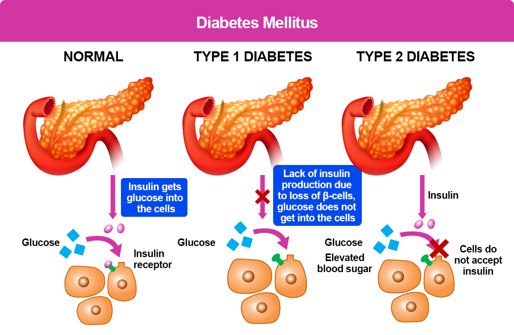 Diabetes-Mellitus-illustration Searching for latest cure of diabetes? Contact Neem Nutraceuticals for 100% cure +254720760419